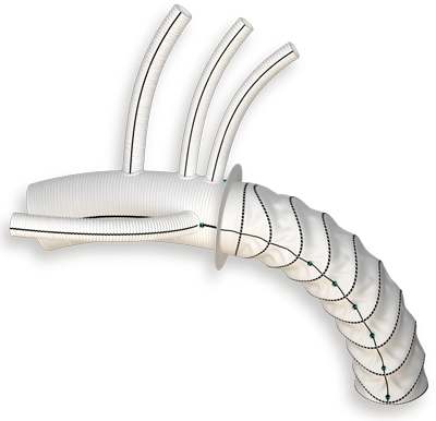 Vascutek produces a portfolio of implants for treating patients with aortic disease